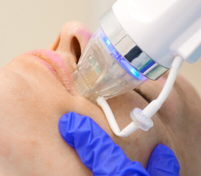 Microneedling com RF e terapia de LED